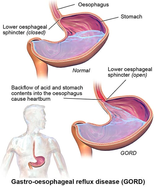 A diagram of the effects of GORD