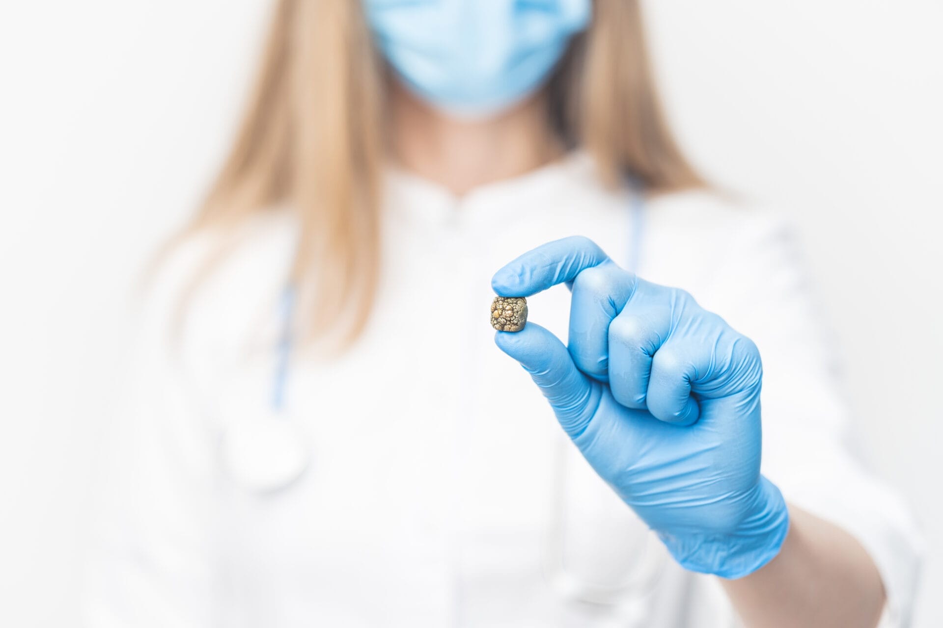 gallstone in the doctor's hand